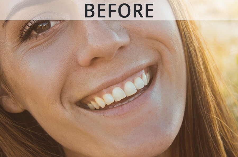 before teeth whitening in lightroom1